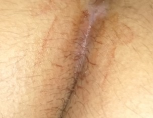 Post Surgery Wound Bleeding 