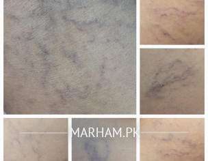 There Is Slight Itching