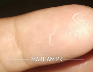 Frequent Threadworms