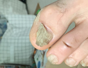 Nail Issue