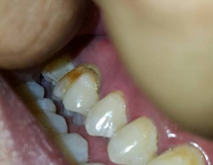 Dental Pain