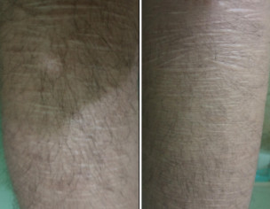 Self Harm Scars Removal