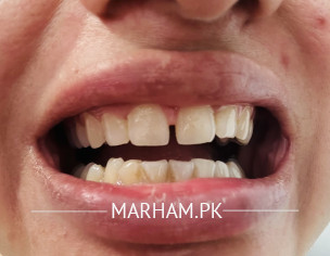 Gap Between Teeth