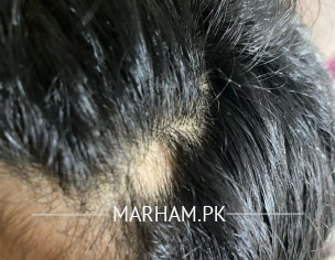 Hair Loss Patch