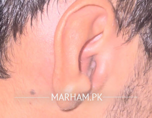 Ear Sore And Extreme Pain