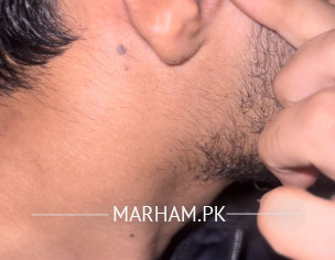 Ear Sore And Extreme Pain