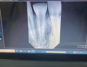 Half Front Teeth Broken