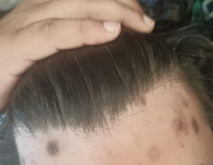 Plantar Warts On Forehead