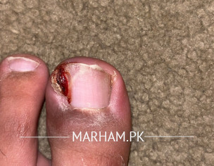 Toe Fungus