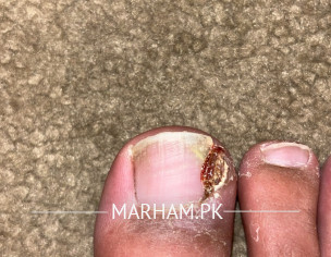 Toe Fungus