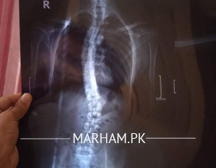 Scoliosis Back Bone Issue