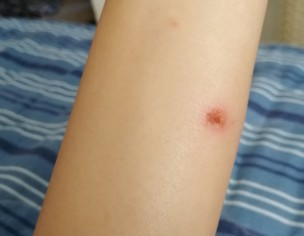 Skin Issue