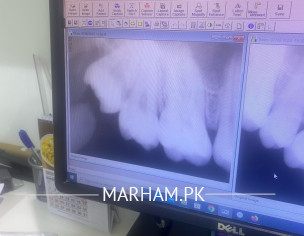 Eye Pain And Swelling 