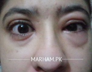 Eye Allergy And Itching, Swelling