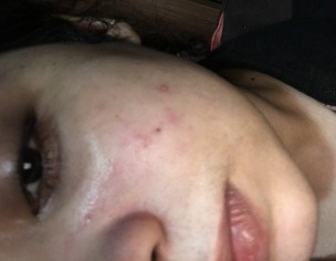 Acne And Redness