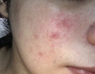 Acne And Redness
