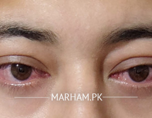 Redness In Eyes