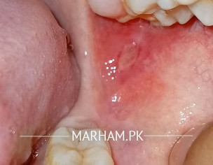 Upper Jaw Wisdom Teeth