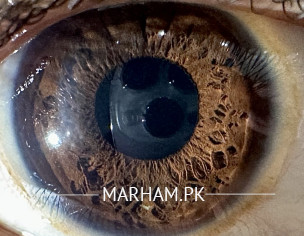 Yellow Ring Around Eye Ball