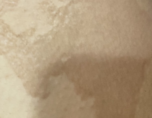 Skin Issue