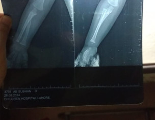 Bone Fracture In Arm