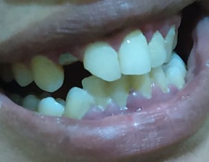 Broken Tooth Treatment