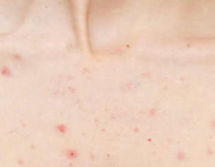 Chest Acne Small Red Bumps