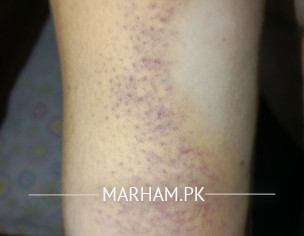 Bruise Type Mark On Right Upper Arm