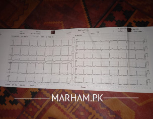 Fast Heartbeat/high Pulse Rate