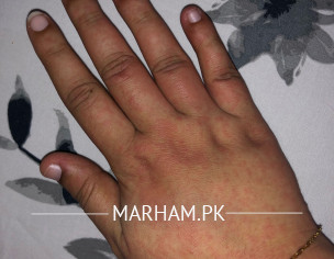 Rash After Typhoid 