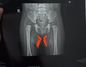 Rashes On Upper Thighs