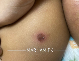 Blisters Or Skin Issue?