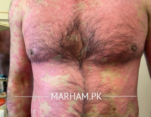 Psoriasis 