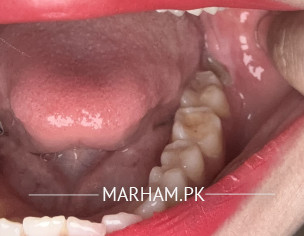 Gingivitis During Ovulation Induction