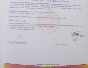 Kidney Stones With Hydronephrosis