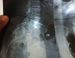 Spinal Stenosis
