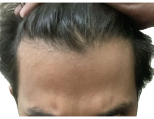 Hair Fall, Alopecia