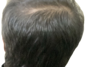 Hair Fall, Alopecia
