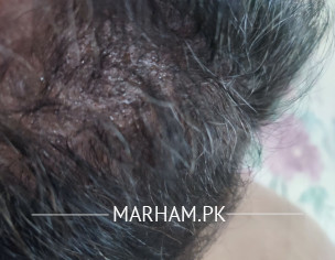 Neutrophils On Scalp