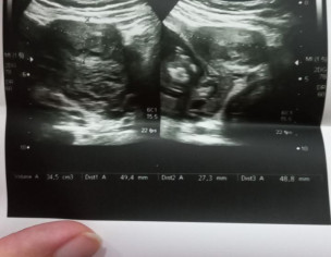 Lateral Ventricle Range 6mm