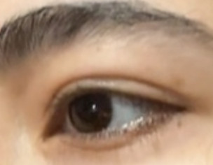 Eye Lid Swelling