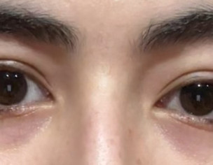Eye Lid Swelling