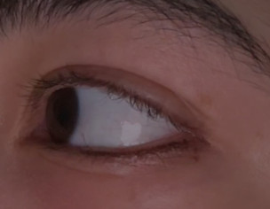 Eye Lid Swelling
