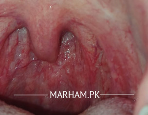 Pharyngitis