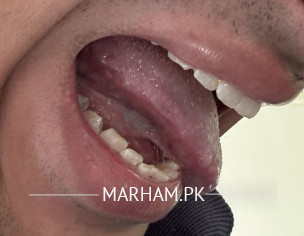 White Appearances On The Tongue.