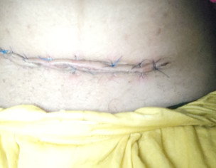 Csection Scar