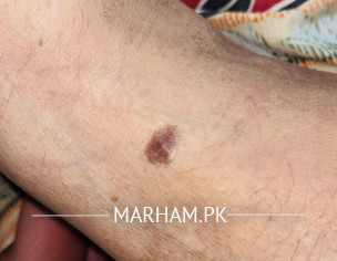 Skin Issue Black Spots