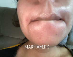 Stubborn Acne Problem 