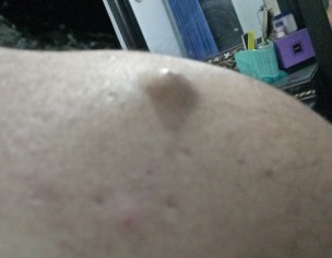Wart Type Thing On Back