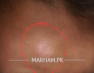 Dry Skin Patch On Forehead